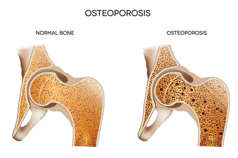 cid osteoporose - cid 52